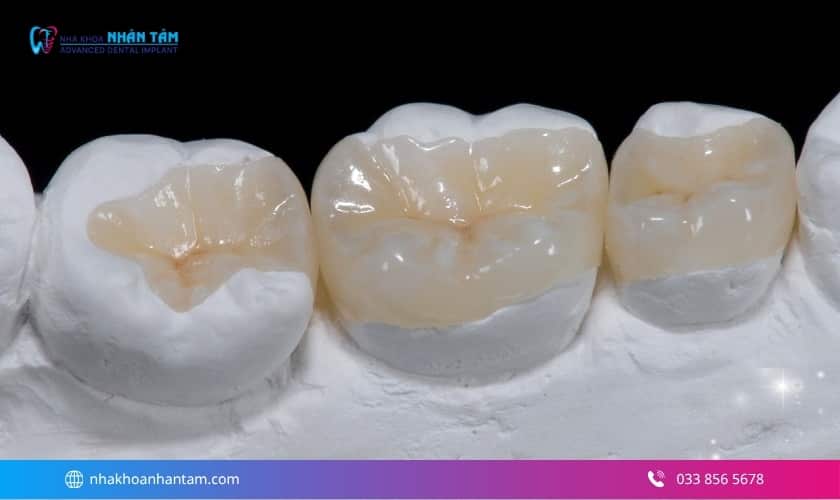 trám răng hết bao nhiêu tiền