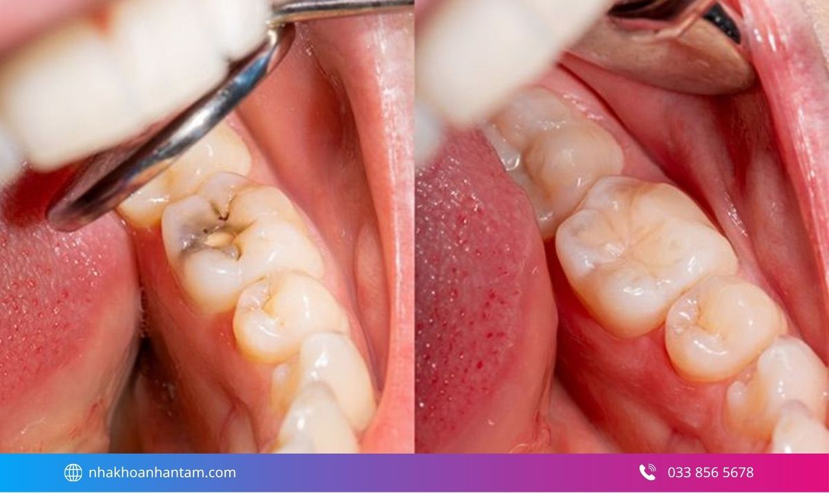 Trám răng sâu là phương pháp phục hồi phần mô răng bị mất do sâu răng Hình: Trám răng sâu là phương pháp phục hồi phần mô răng bị mất do sâu răng