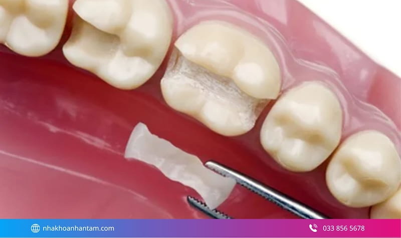 trám răng thẩm mỹ cho răng sâu