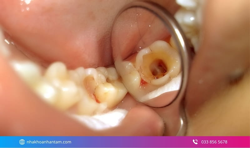 trám răng thẩm mỹ có bền không