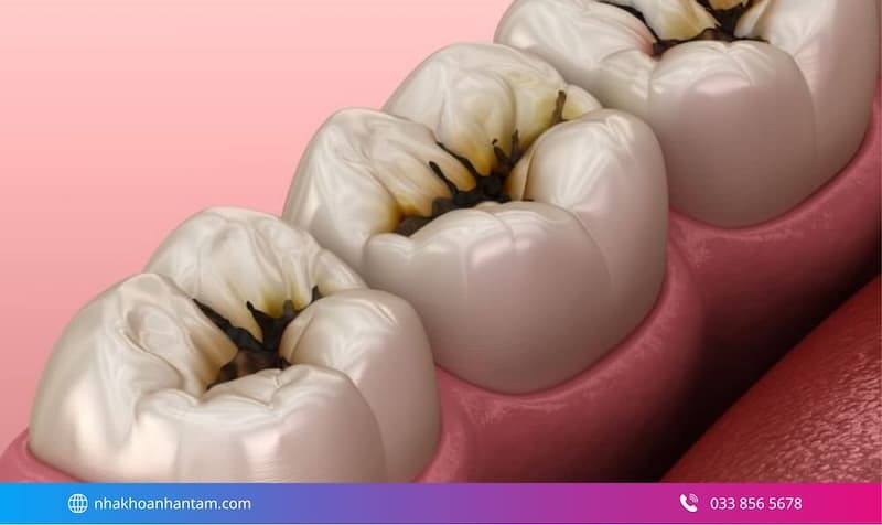 trám răng thẩm mỹ có đau không