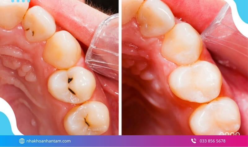 trám răng thẩm mỹ composite