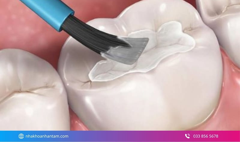 trám răng thẩm mỹ giữ được bao lâu