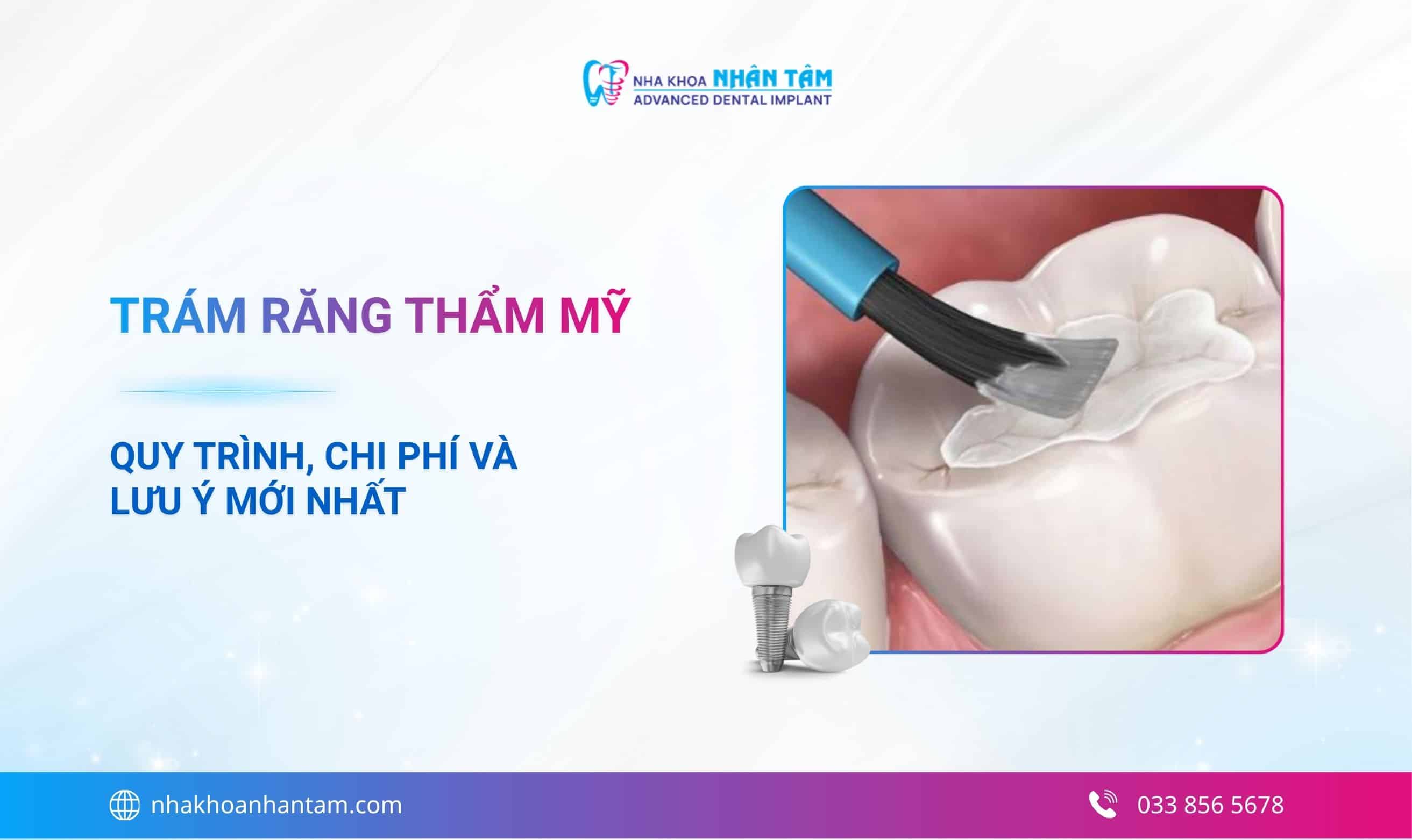 Trám răng thẩm mỹ: Quy trình, chi phí và lưu ý năm 2026