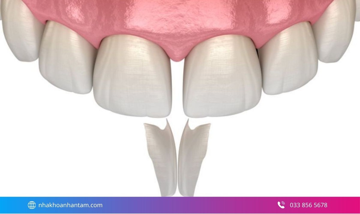 Trám răng thưa giúp bảo tồn răng thật Hình: Trám răng thưa giúp bảo tồn răng thật