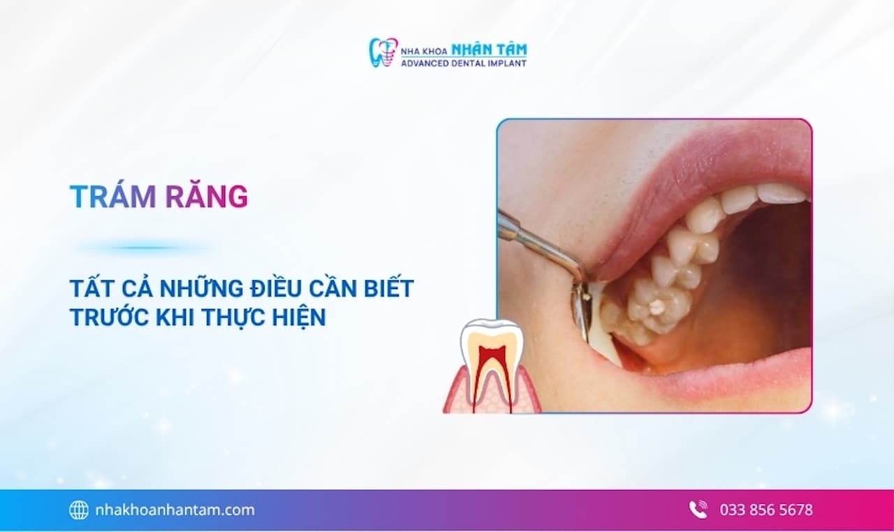 Trám răng: Tất cả những điều cần biết trước khi thực hiện