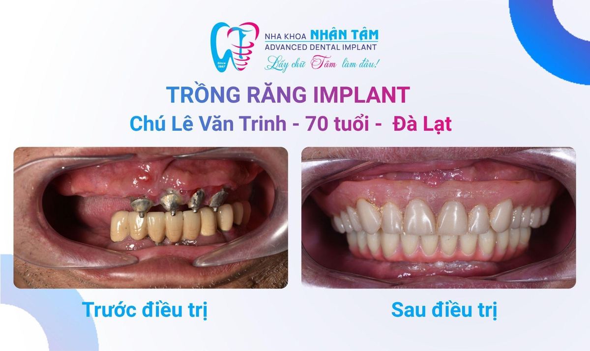 Hình: Chú Lê Văn Trinh – Câu chuyện khách hàng tại Nha khoa Nhân Tâm