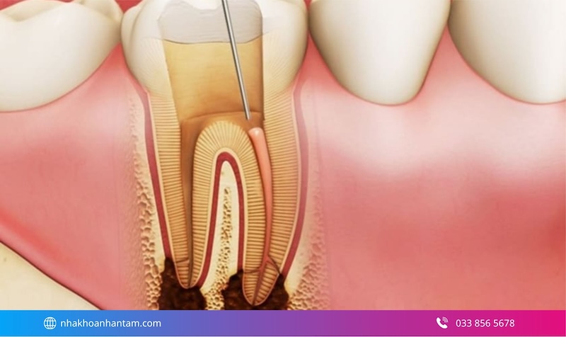 triệu chứng viêm tủy răng