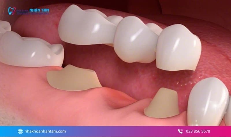 trồng răng giả có tốt không