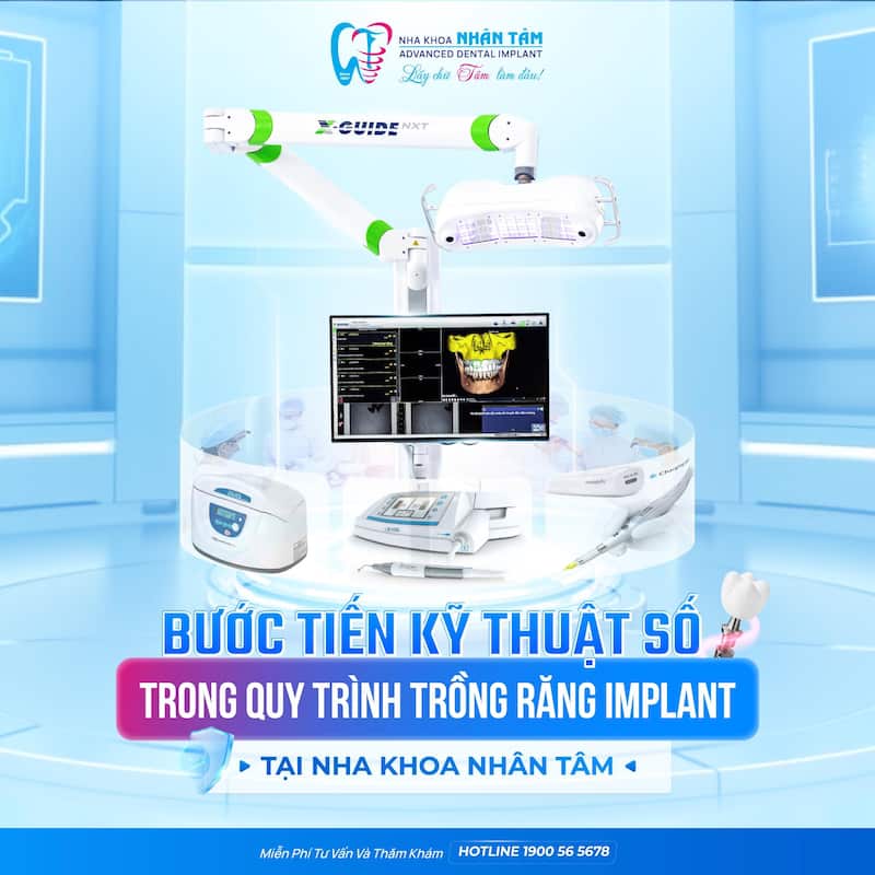 tuổi thọ răng implant