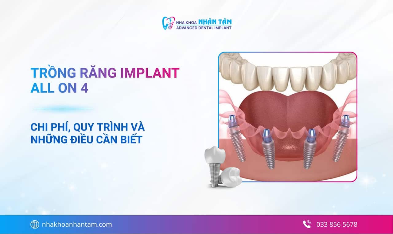 Trồng răng Implant All On 4 là gì? Chi phí, quy trình và những điều cần biết