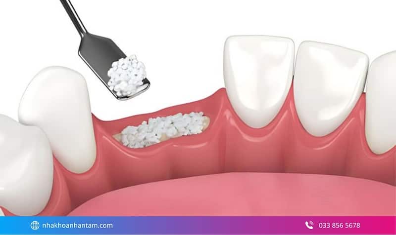 trồng răng implant all on 6 cho mất răng lâu năm