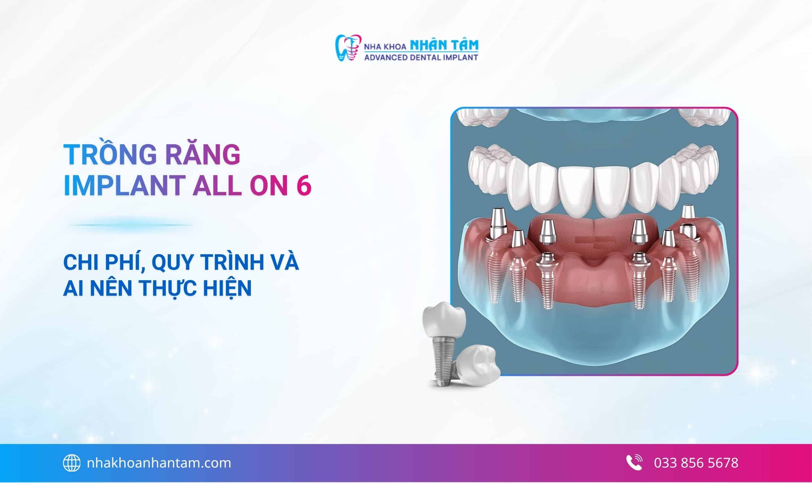 Trồng răng Implant All On 6: Chi phí, quy trình và ai nên thực hiện