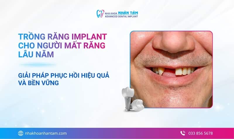 Trồng Implant: Giải pháp tối ưu cho người mất răng lâu năm
