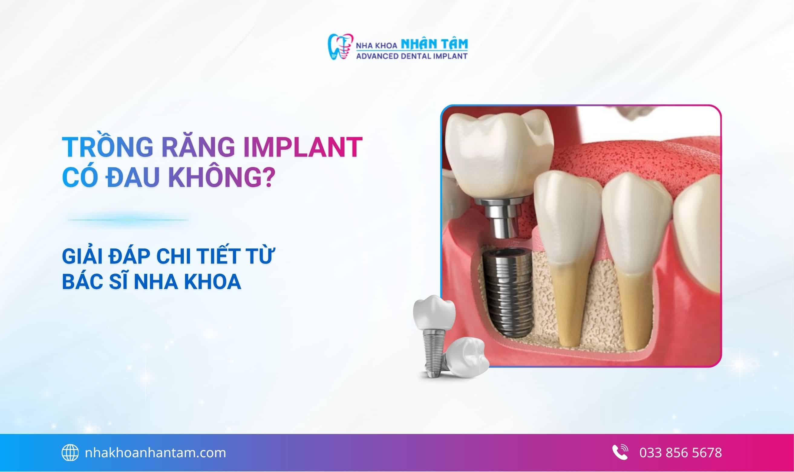 Trồng răng Implant có đau không? Giải đáp chi tiết từ bác sĩ nha khoa