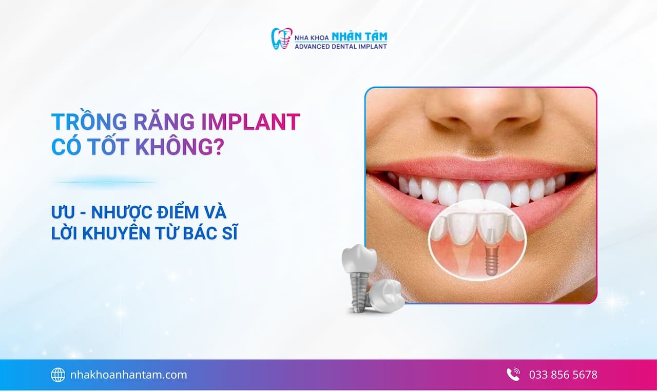 Hình: Trồng răng Implant có tốt không? Ưu - nhược điểm và lời khuyên từ bác sĩ