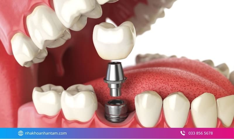 implant dùng được bao lâu