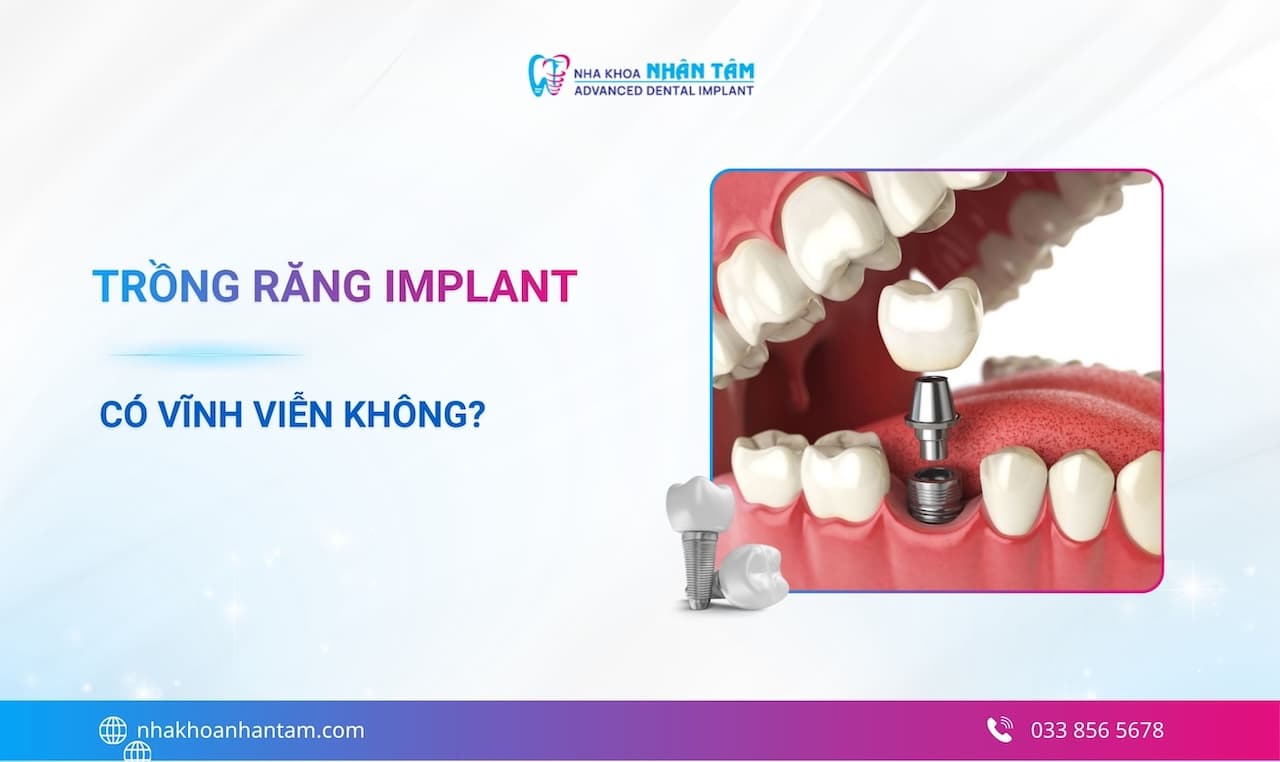 Giải đáp: Trồng răng Implant có vĩnh viễn không?