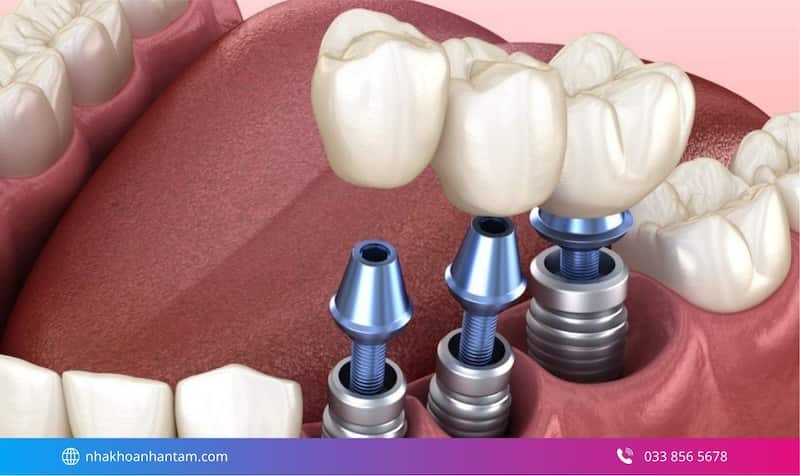 trồng răng implant khi bị tiêu xương