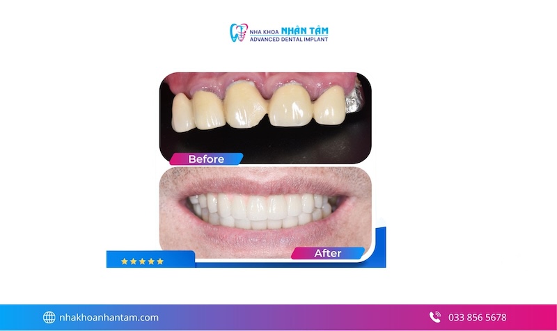 trồng răng implant không đau