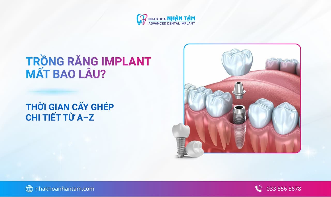 Trồng răng Implant mất bao lâu? Thời gian cấy ghép chi tiết từ A–Z Hình: Trồng răng Implant mất bao lâu? Thời gian cấy ghép chi tiết từ A–Z