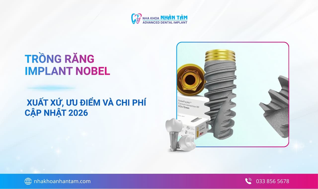 Hình: Trồng răng Implant Nobel: Xuất xứ, ưu điểm và chi phí cập nhật 2026