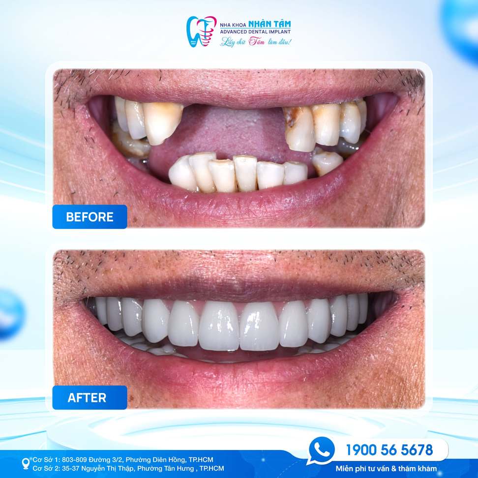 Hình: Trồng răng Implant là giải pháp được nhiều người lựa chọn