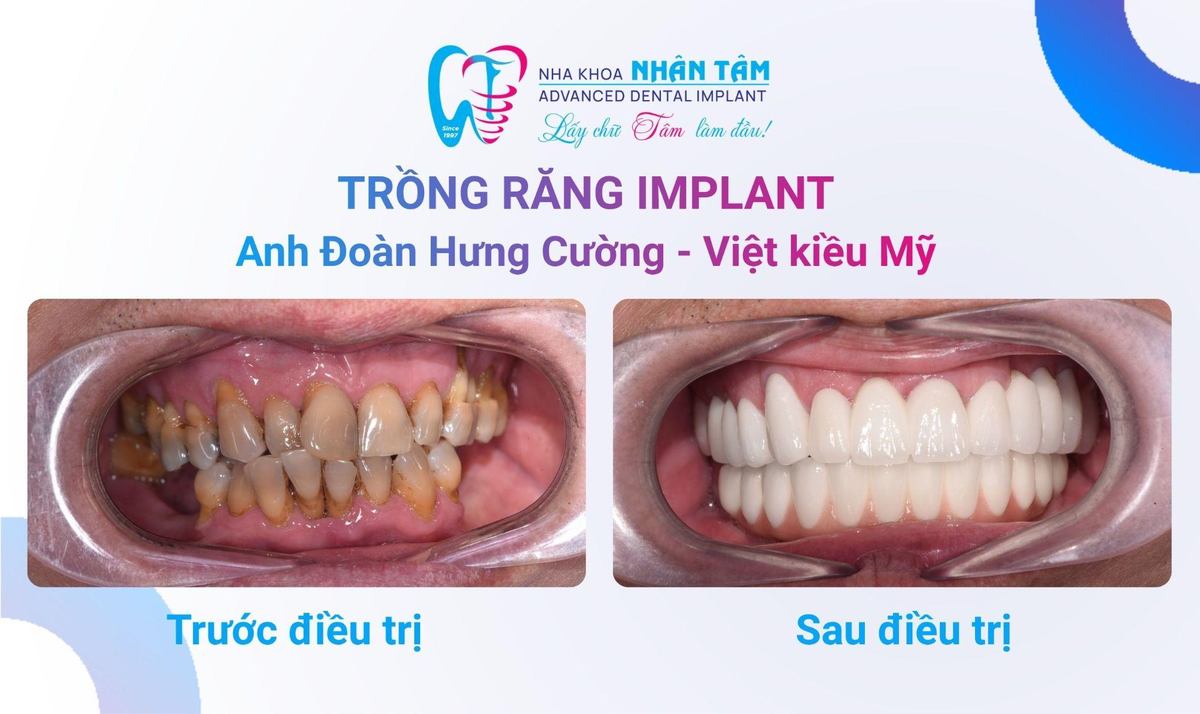 Hình: Anh Đoàn Hưng Cường (Việt kiều Mỹ) – Câu chuyện khách hàng tại Nha khoa Nhân Tâm