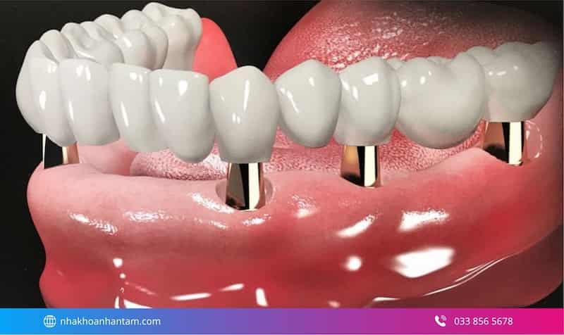 trồng răng implant toàn hàm có tốt không