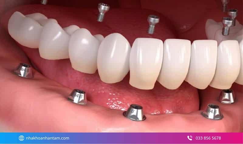 trồng răng implant toàn hàm mất bao lâu