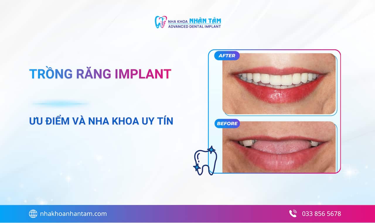 Trồng răng Implant là gì? Ưu điểm và quy trình cấy ghép Implant 2026 Trồng răng Implant là gì? Ưu điểm và quy trình cấy ghép Implant 2026