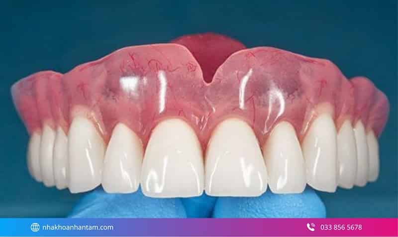 trồng răng toàn hàm all on 6