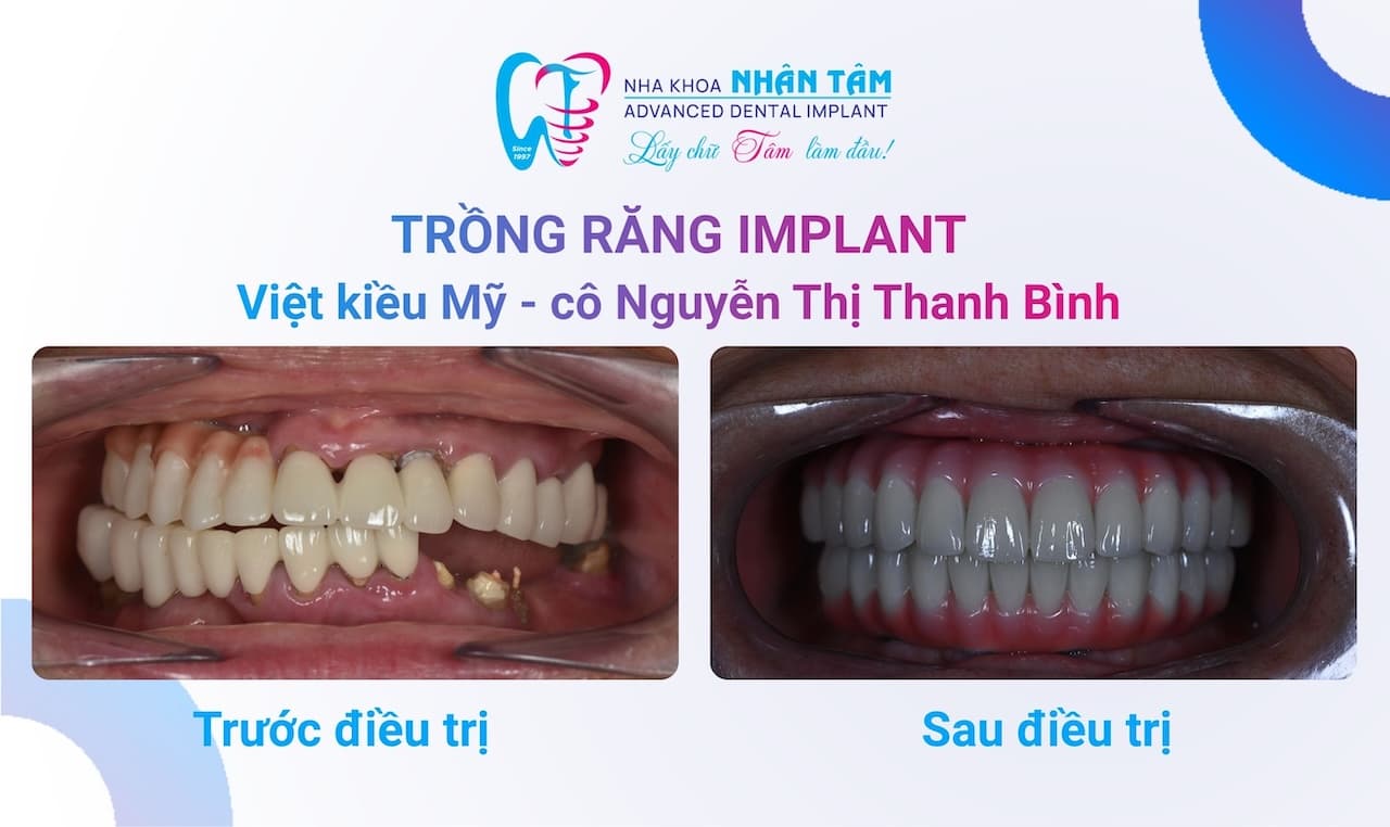 Trồng Răng Toàn Hàm – Khi Ăn Uống Trở Lại Là Niềm Vui Trồng Răng Toàn Hàm – Khi Ăn Uống Trở Lại Là Niềm Vui