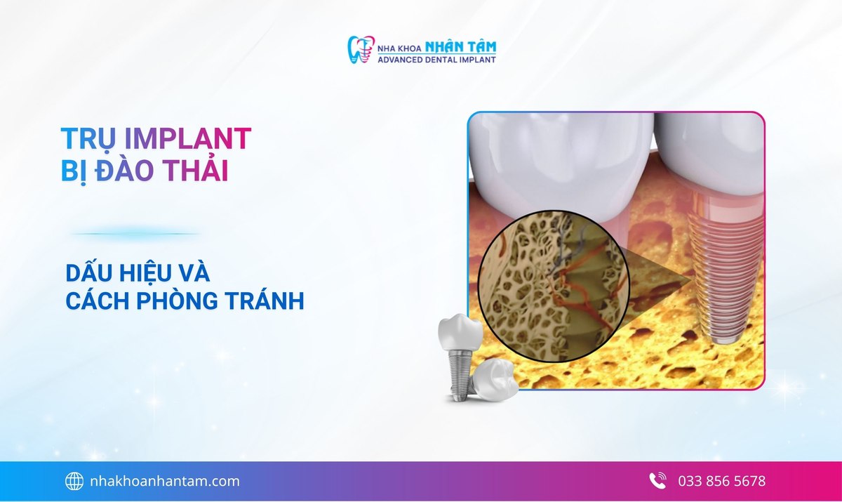 Trụ implant bị đào thải: Dấu hiệu, nguyên nhân và cách xử lý