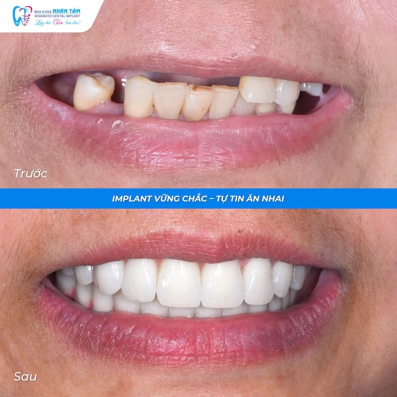 implant biotem hàn quốc