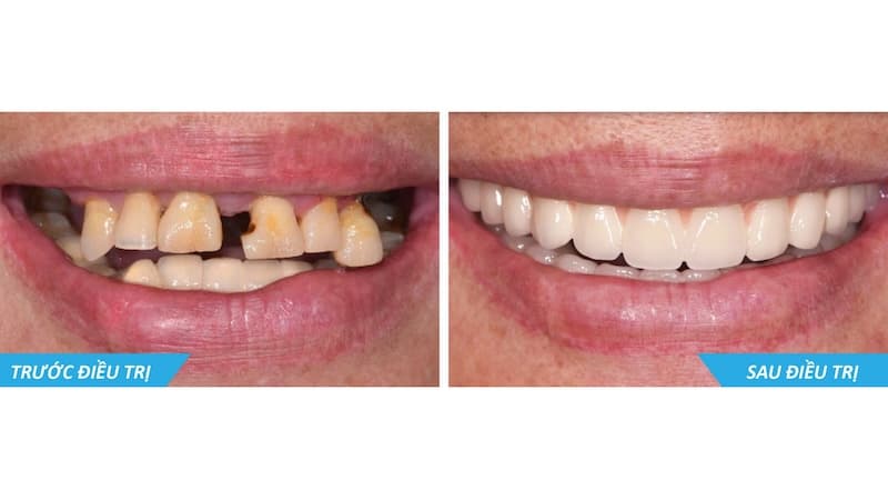 chi phí cấy ghép implant dentium