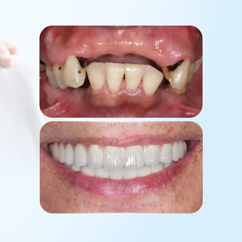 giá trụ implant dentium
