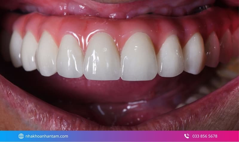 đánh giá trụ implant dio