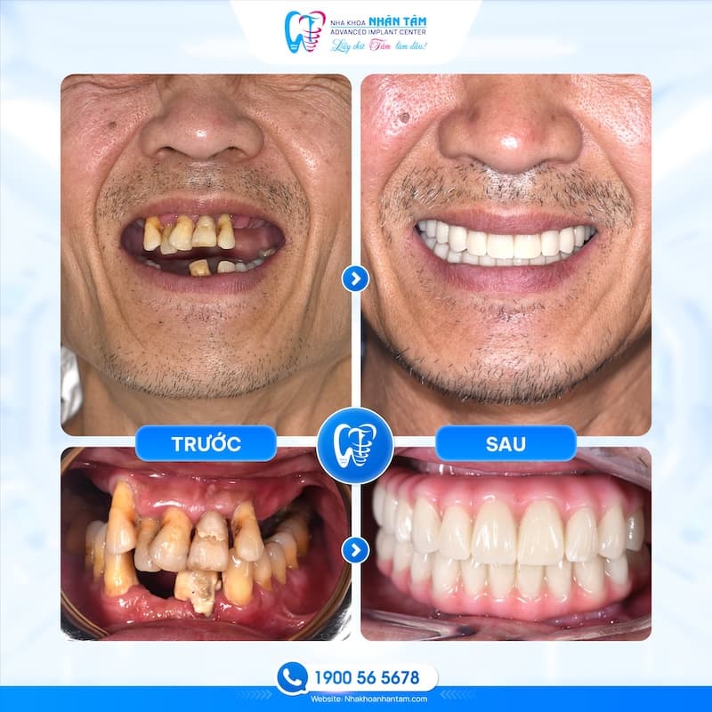 implant megagen hàn quốc