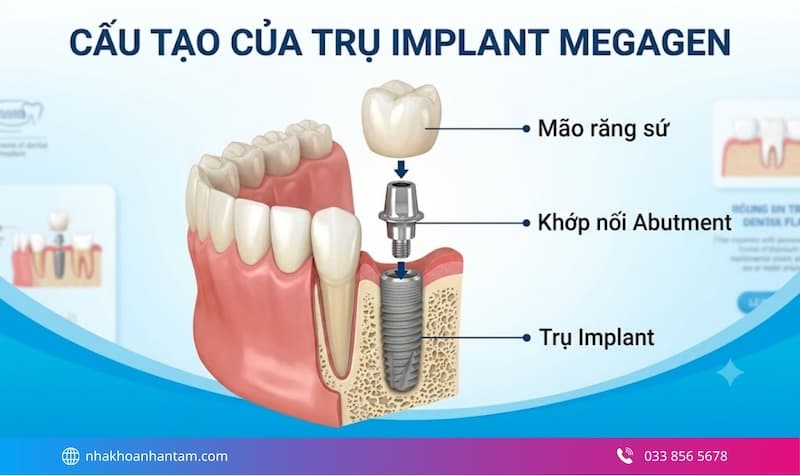trụ implant megagen có tốt không