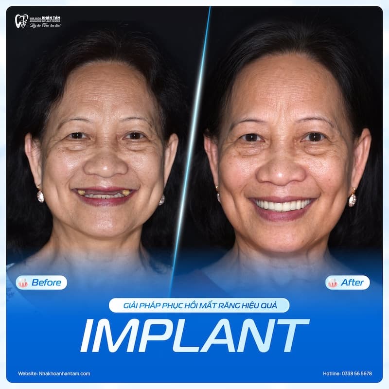 implant neo biotech là gì