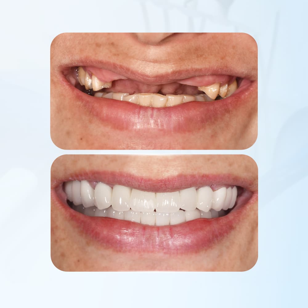 Hình: cân nhắc trước khi chọn trụ implant Osstem