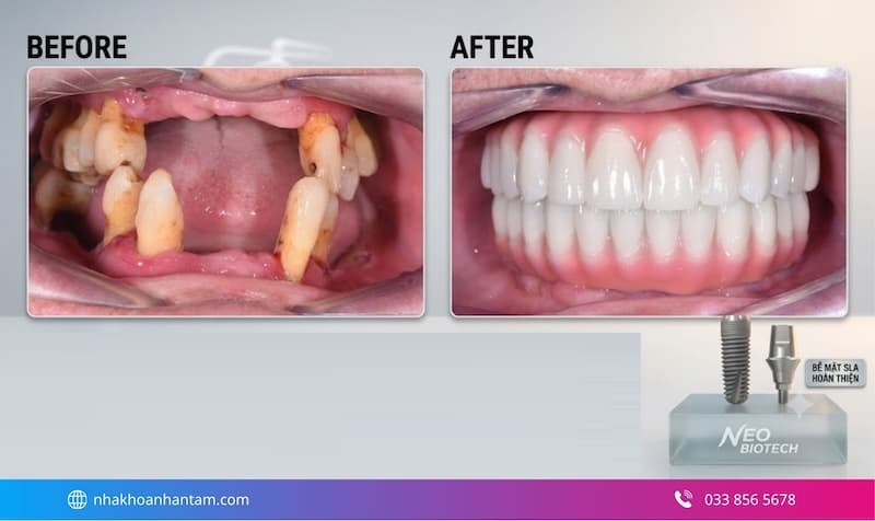 đánh giá trụ implant yes biotech