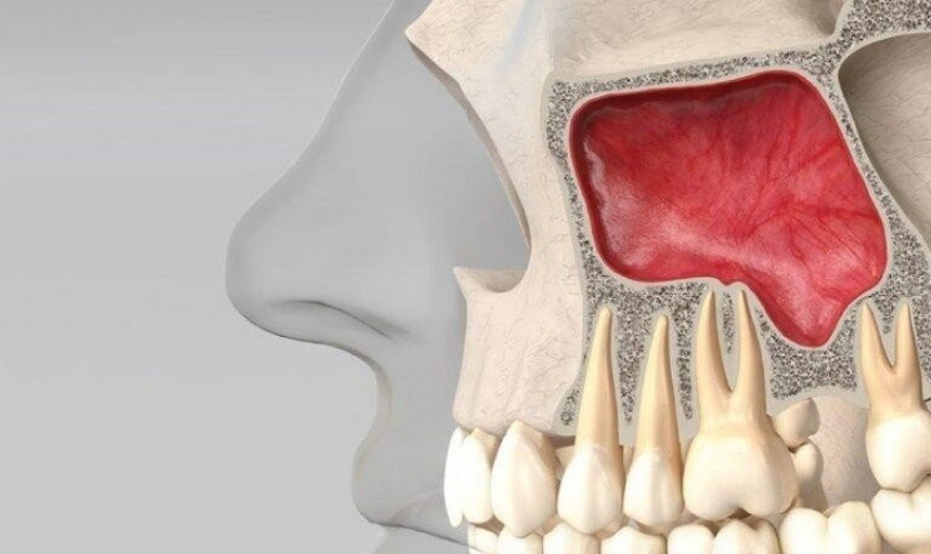 Hình: Khách hàng mắc các bệnh lý xoang cấp tính cần điều trị ổn định trước khi tiến hành phẫu thuật nâng xoang cấy ghép implant