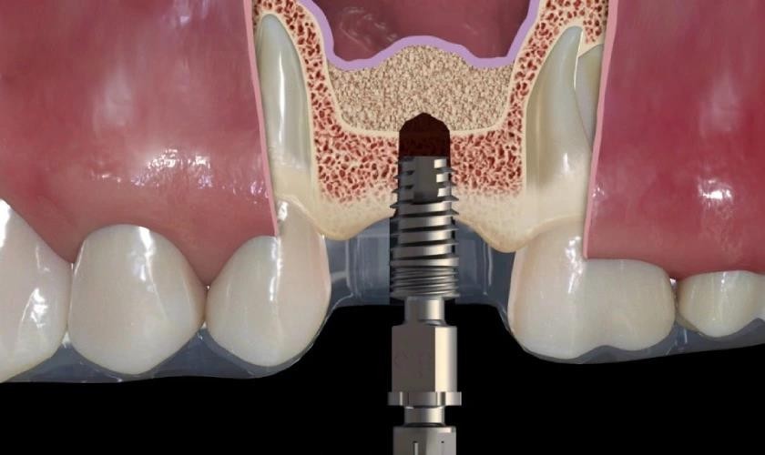 Hình: Những trường hợp được bác sĩ chỉ định nâng xoang trong cấy ghép implant