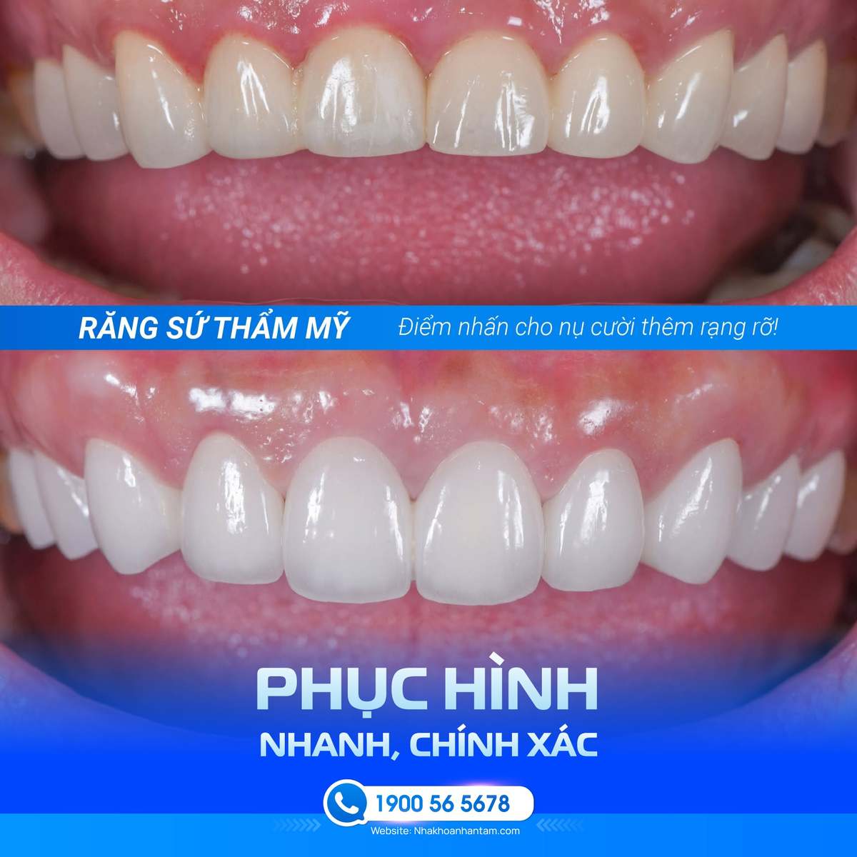 Hình: Phục hình sứ được cân nhắc để cải thiện màu sắc và hình dáng răng