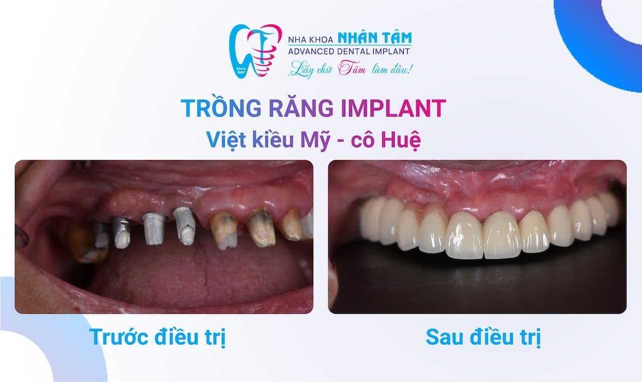 Từ Mỹ Về Việt Nam Chỉ Để Đến Nhân Tâm Tìm Lại Nụ Cười | Nha Khoa Nhân Tâm