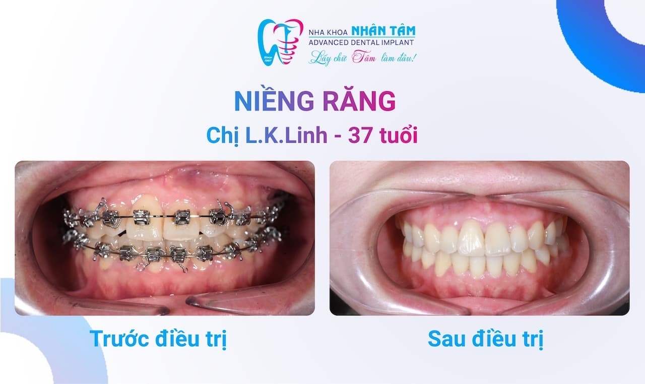 Từ niềng răng đến bọc răng sứ, Nhân Tâm vẫn luôn là lựa chọn hàng đầu