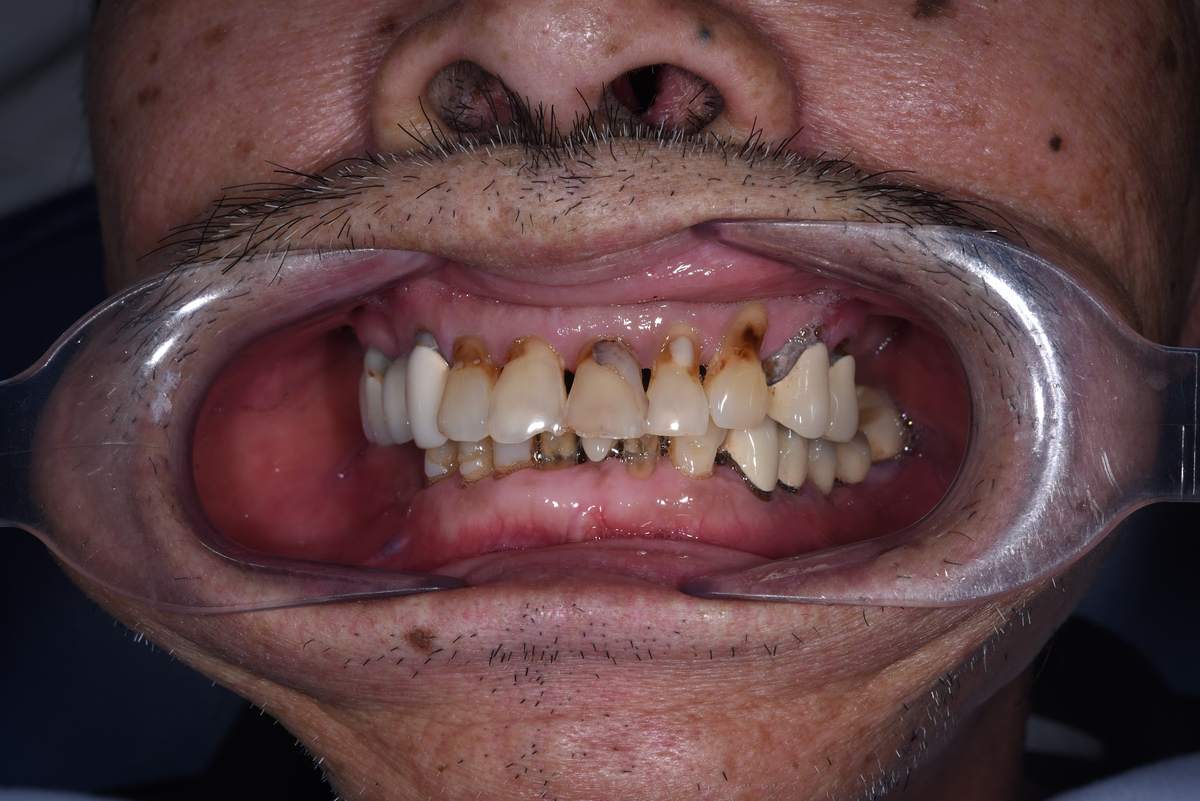 Chú Carl Tang (Việt kiều Mỹ) – Câu chuyện khách hàng tại Nha khoa Nhân Tâm Hình: Chú Carl Tang (Việt kiều Mỹ) – Câu chuyện khách hàng tại Nha khoa Nhân Tâm