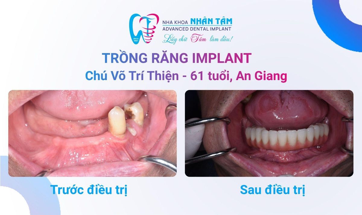 Chú Võ Trí Thiện (61 tuổi) và cô Trần Thị Diễm (54 tuổi) (An Giang) Hình: Chú Võ Trí Thiện (61 tuổi) và cô Trần Thị Diễm (54 tuổi) (An Giang)
